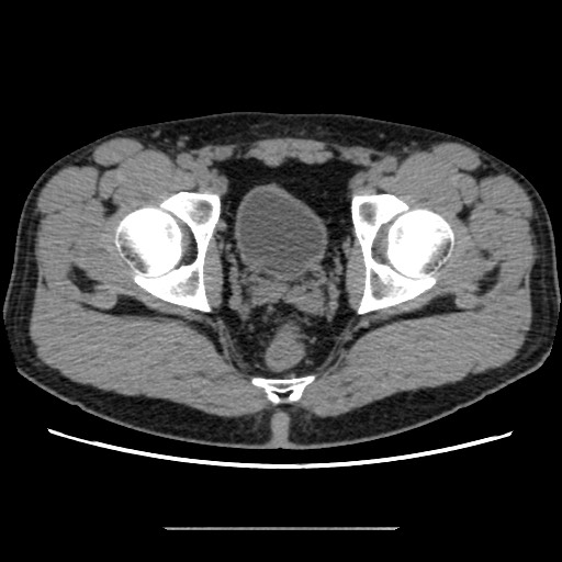 Chondrosarcoma of iliac wing (Radiopaedia 63861-72599 Axial non-contrast 99).jpg