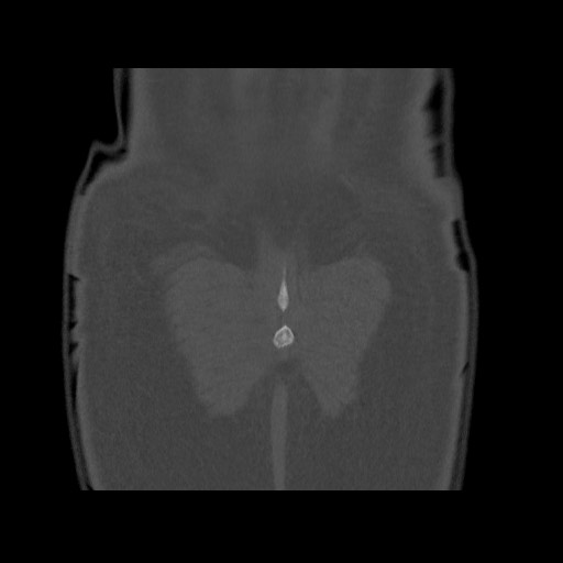Chondrosarcoma of iliac wing (Radiopaedia 63861-72599 Coronal bone window 107).jpg