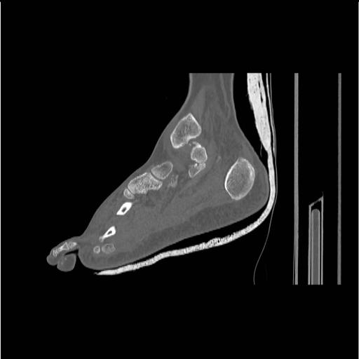 File:Chopart fracture (Radiopaedia 12386-12650 Sagittal bone window 26).jpg