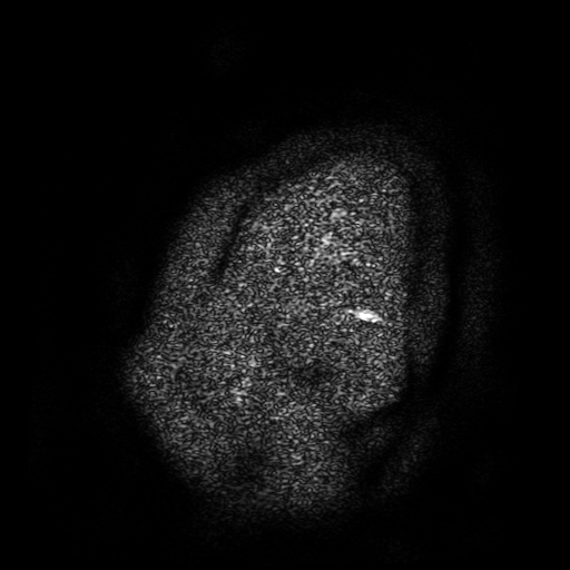 Chordoid glioma of third ventricle (Radiopaedia 91612-109340 F 2).jpg