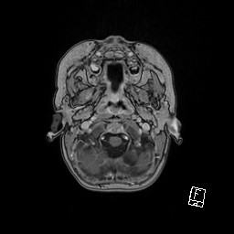 File:Choroid plexus papilloma (Radiopaedia 92022-109829 Axial T1 C+ 5).jpg