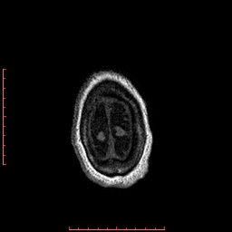 Choroid plexus xanthogranuloma (Radiopaedia 67843-77270 Axial T1 22).jpg