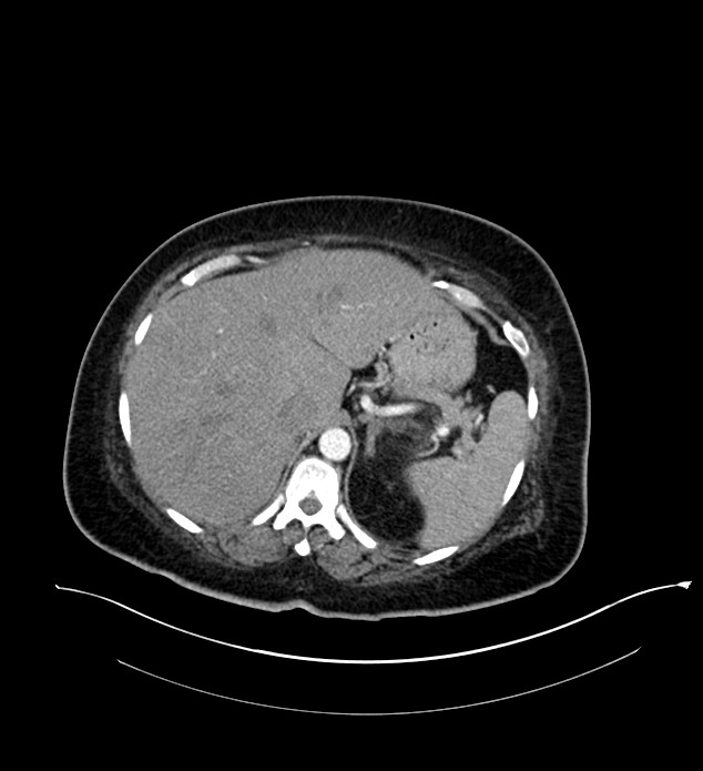 Chromophobe renal cell carcinoma (Radiopaedia 84239-99519 B 20).jpg