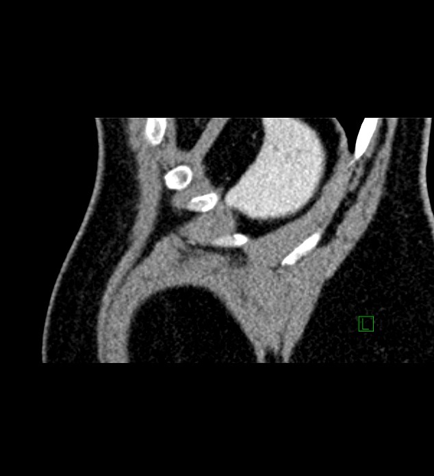 Chromophobe renal cell carcinoma (Radiopaedia 84286-99573 F 4).jpg