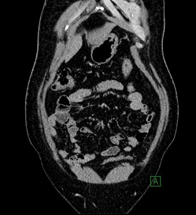 Chromophobe renal cell carcinoma (Radiopaedia 84286-99573 H 34).jpg