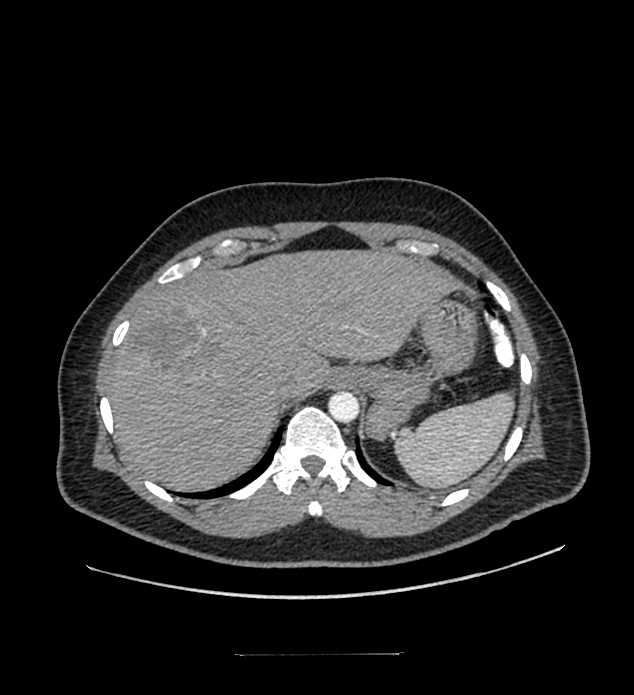 Chromophobe renal cell carcinoma (Radiopaedia 84337-99644 B 14).jpg