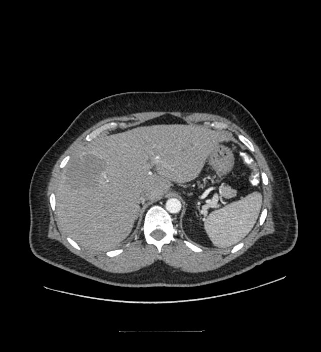 Chromophobe renal cell carcinoma (Radiopaedia 84337-99644 B 17).jpg