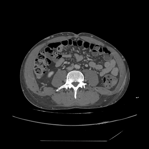 File:Chronic IVC thrombosis and resultant IVC filter malposition (Radiopaedia 81158-94800 A 133).jpg