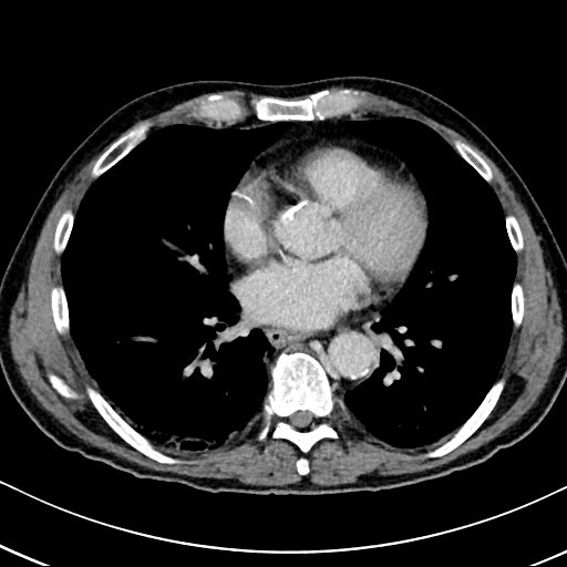 Chronic appendicitis complicated by appendicular abscess, pylephlebitis and liver abscess (Radiopaedia 54483-60700 B 8).jpg