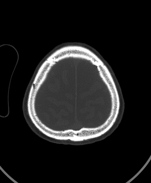 Chronic bilateral subdural hygroma (Radiopaedia 85801-101623 Axial bone window 25).jpg