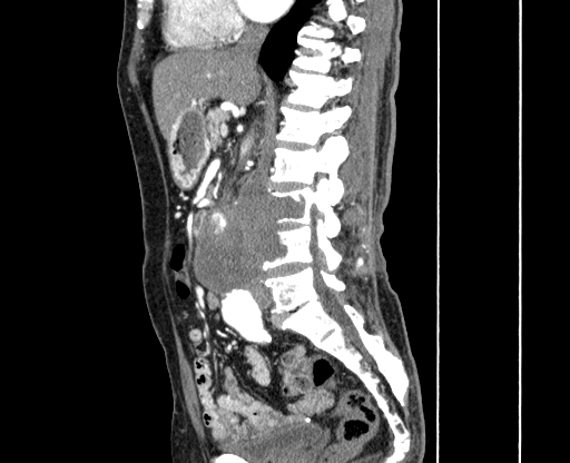 File:Chronic contained rupture of abdominal aortic aneurysm with extensive erosion of the vertebral bodies (Radiopaedia 55450-61901 B 25).jpg