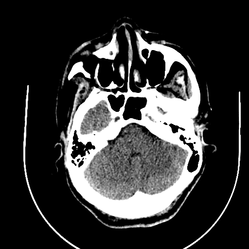Chronic invasive fungal sinusitis (Radiopaedia 91563-109286 Axial non-contrast 19).jpg