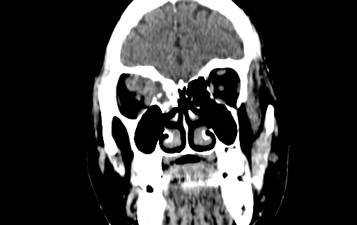 Chronic invasive fungal sinusitis (Radiopaedia 91563-109286 D 32).jpg