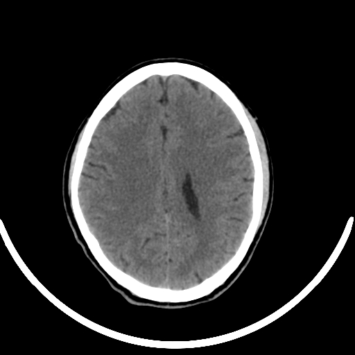File:Chronic invasive fungal sinusitis with intraorbital and intracranial extension (Radiopaedia 56387-63046 Axial non-contrast 245).jpg