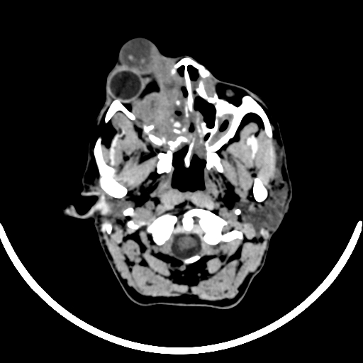 File:Chronic invasive fungal sinusitis with intraorbital and intracranial extension (Radiopaedia 56387-63046 Axial non-contrast 83).jpg