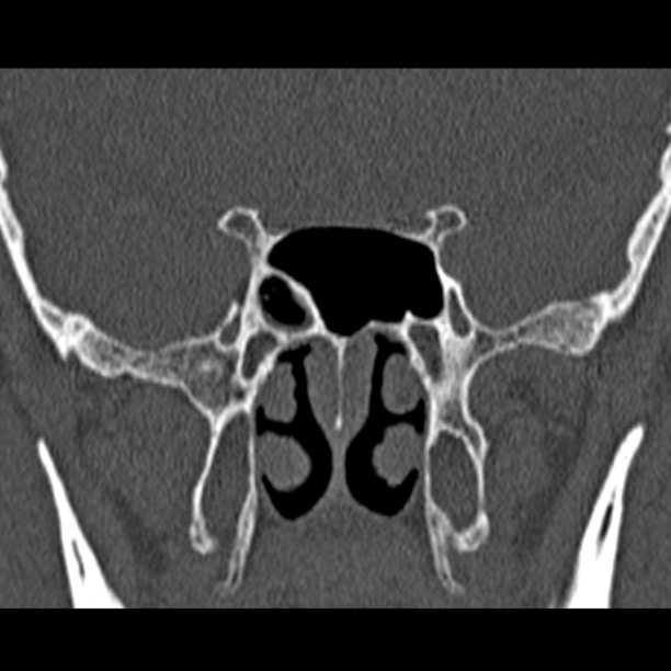 Chronic maxillary sinusitis (Radiopaedia 27879-28116 Coronal bone window 42).jpg