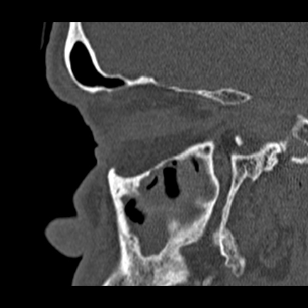 Chronic maxillary sinusitis (Radiopaedia 27879-28116 Sagittal bone window 15).jpg