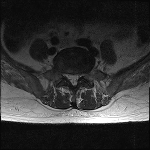 File:Chronic myeloid leukemia (MRI) (Radiopaedia 56128-62777 Axial T2 18).jpg