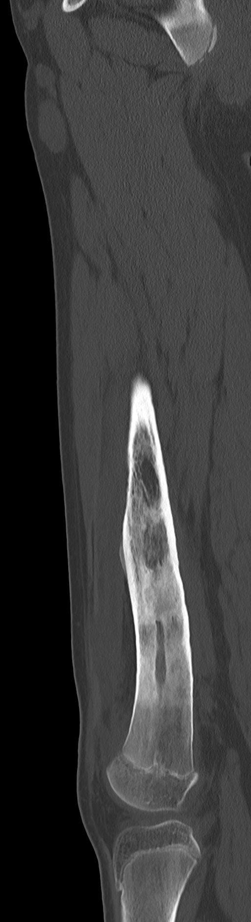 Chronic ostemyelitis of the femur with long sinus tract (Radiopaedia 74947-85982 Sagittal bone window 51).jpg