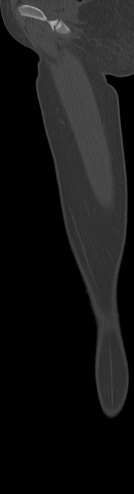 Chronic ostemyelitis of the femur with long sinus tract (Radiopaedia 74947-85982 Sagittal bone window 80).jpg