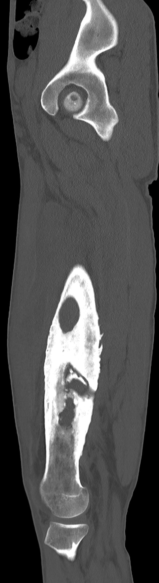Chronic osteomyelitis (with sequestrum) (Radiopaedia 74813-85822 C 78).jpg
