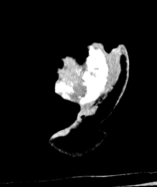 Chronic osteomyelitis - calvarial (severe) (Radiopaedia 69668-79616 Coronal non-contrast 68).jpg