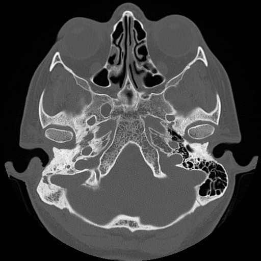 File:Chronic otomastoiditis (Radiopaedia 27138-27309 Axial bone window 19).jpg