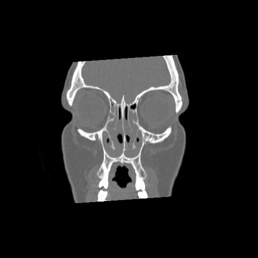 File:Chronic sinusitis with intra-sinus calcification (Radiopaedia 63919-72668 Coronal bone window 8).jpg