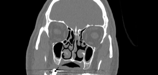 Chronic sphenoidal sinusitis (Radiopaedia 62030-70122 Coronal bone window 60).jpg