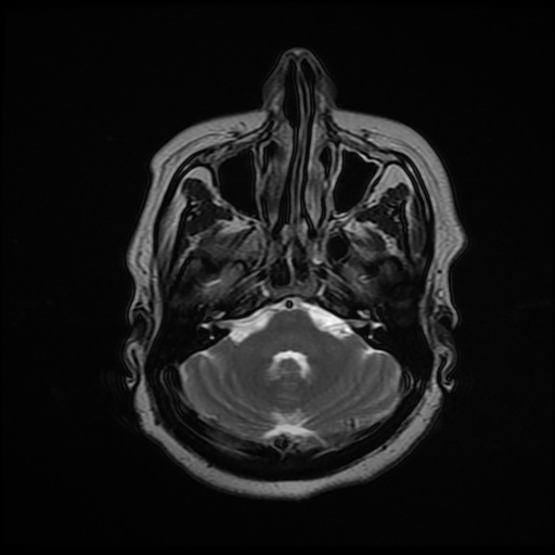 File:Chronic submandibular sialadenitis (Radiopaedia 61852-69885 Axial T2 1).jpg