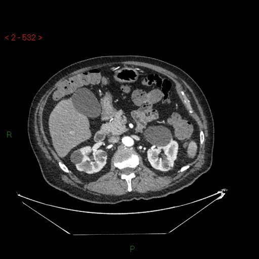 File:Circumaortic left renal vein and doubled left renal arteries (Radiopaedia 52268-58158 A 68).jpg