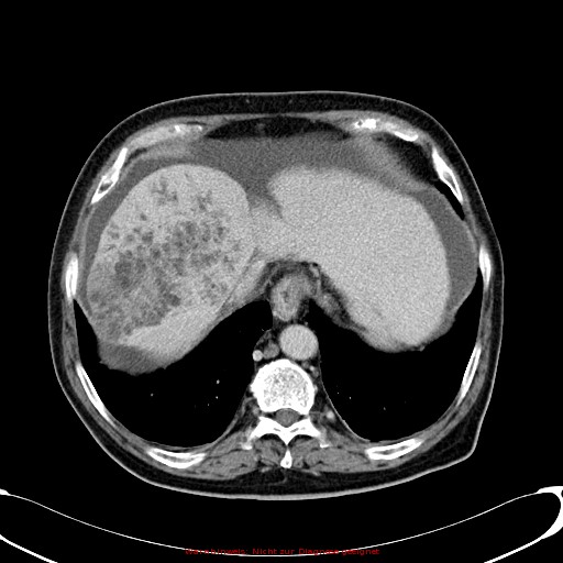 File:Cirrhosis and hepatocellular carcinoma in the setting of hemochromatosis (Radiopaedia 75394-86595 B 19).jpg