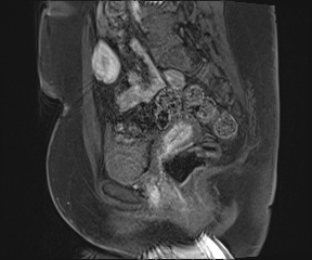 File:Class II Mullerian duct anomaly- unicornuate uterus with rudimentary horn and non-communicating cavity (Radiopaedia 39441-41755 G 48).jpg