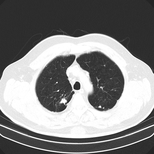 Classic complicated silicosis (Radiopaedia 49720-54961 Axial lung window 12).jpg