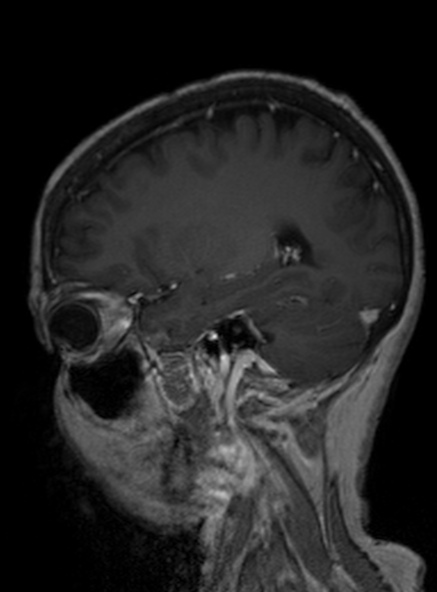 Clival meningioma (Radiopaedia 53278-59248 Sagittal T1 C+ 310).jpg