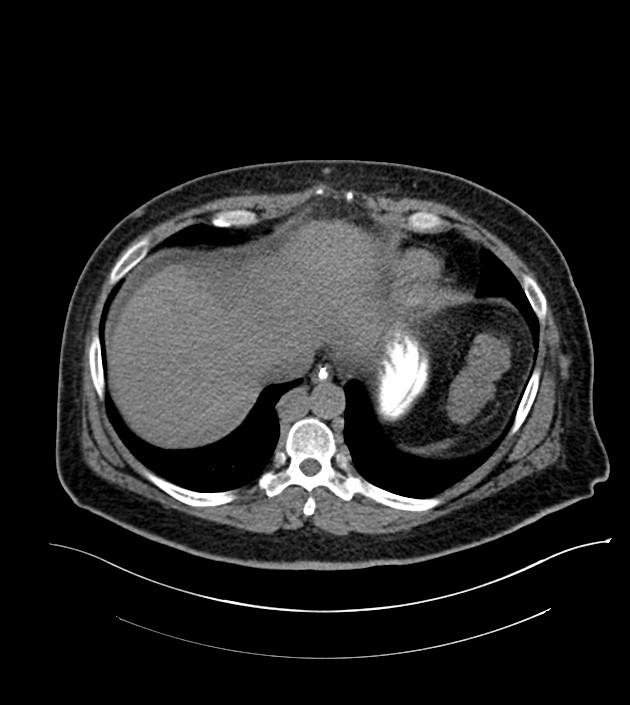 Closed-loop small bowel obstruction-internal hernia (Radiopaedia 78439-91096 Axial non-contrast 21).jpg