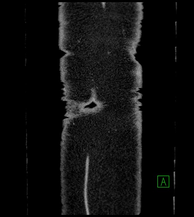 Closed-loop small bowel obstruction-internal hernia (Radiopaedia 78439-91096 Coronal non-contrast 105).jpg