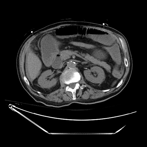 File:Closed loop obstruction due to adhesive band, resulting in small bowel ischemia and resection (Radiopaedia 83835-99023 Axial non-contrast 58).jpg