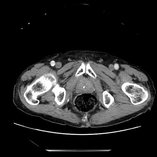File:Closed loop small bowel obstruction - adhesive disease and hemorrhagic ischemia (Radiopaedia 86831-102990 A 178).jpg
