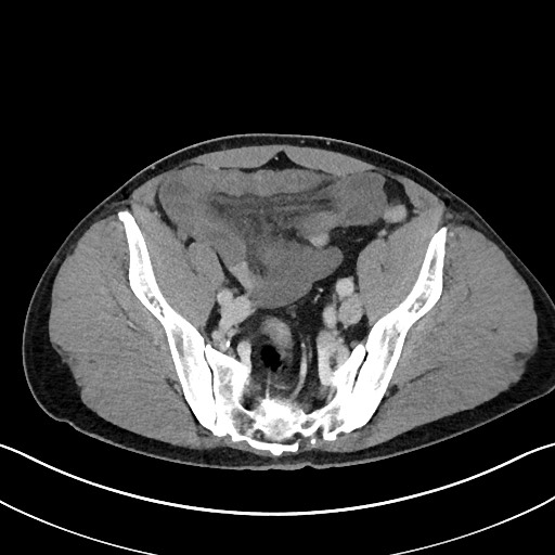 File:Closed loop small bowel obstruction - internal hernia (Radiopaedia 57806-64778 B 100).jpg