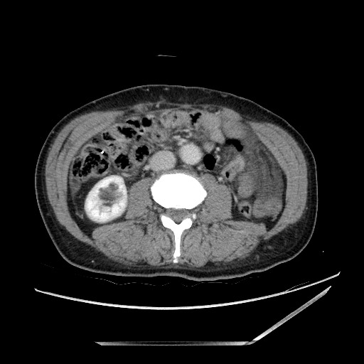 File:Closed loop small bowel obstruction - omental adhesion causing "internal hernia" (Radiopaedia 85129-100682 A 85).jpg