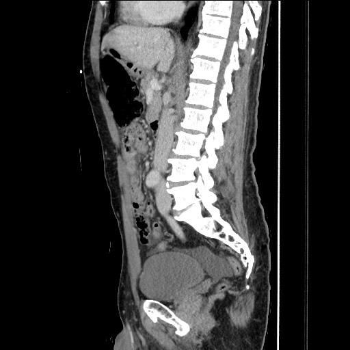 Closed loop small bowel obstruction - omental adhesion causing "internal hernia" (Radiopaedia 85129-100682 C 89).jpg