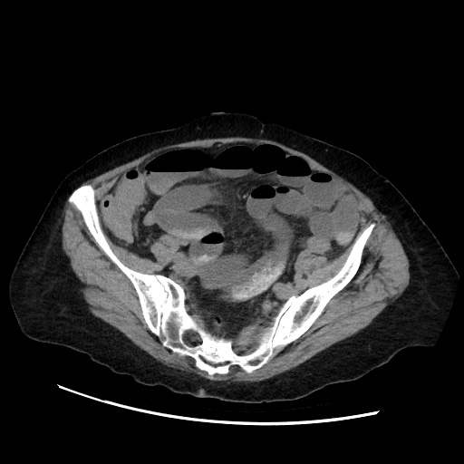 Closed loop small bowel obstruction due to adhesive band, with intramural hemorrhage and ischemia (Radiopaedia 83831-99017 Axial non-contrast 120).jpg