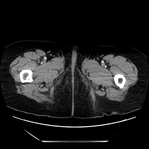 File:Closed loop small bowel obstruction due to adhesive bands - early and late images (Radiopaedia 83830-99014 Axial 174).jpg