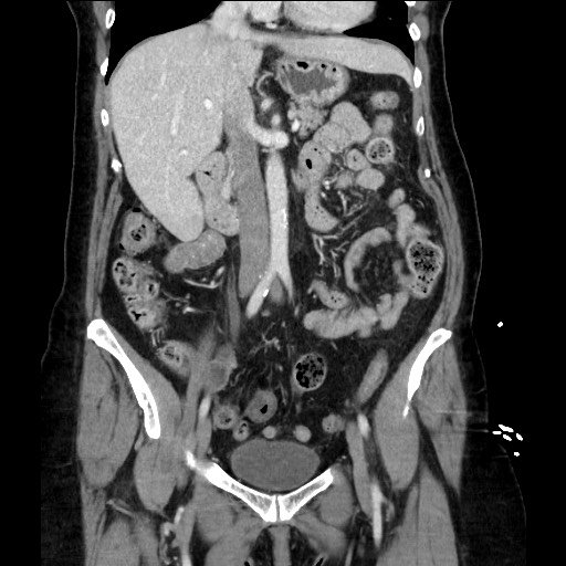 Closed loop small bowel obstruction due to adhesive bands - early and late images (Radiopaedia 83830-99014 B 58).jpg