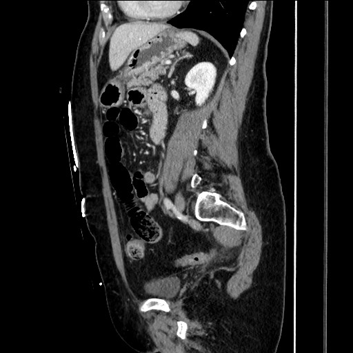 File:Closed loop small bowel obstruction due to adhesive bands - early and late images (Radiopaedia 83830-99014 C 113).jpg
