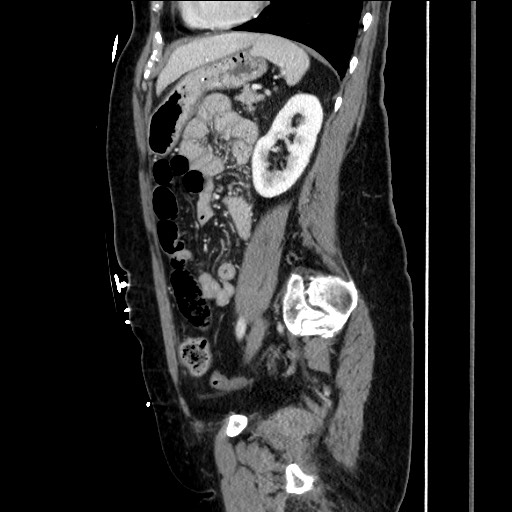 Closed loop small bowel obstruction due to adhesive bands - early and late images (Radiopaedia 83830-99014 C 122).jpg
