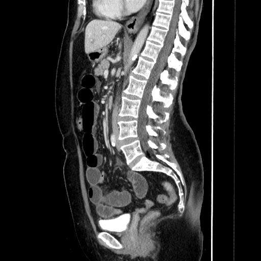 Closed loop small bowel obstruction due to adhesive bands - early and late images (Radiopaedia 83830-99015 C 91).jpg