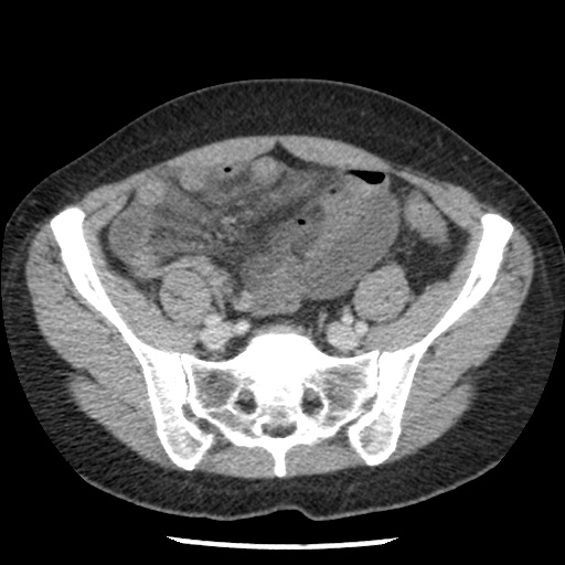 File:Closed loop small bowel obstruction due to trans-omental herniation (Radiopaedia 35593-37109 A 64).jpg