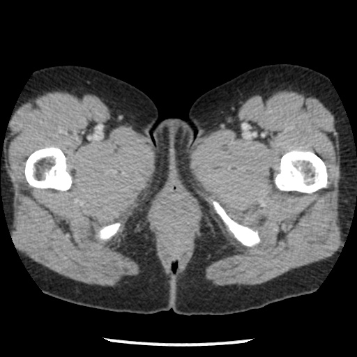 Closed loop small bowel obstruction due to trans-omental herniation (Radiopaedia 35593-37109 A 94).jpg
